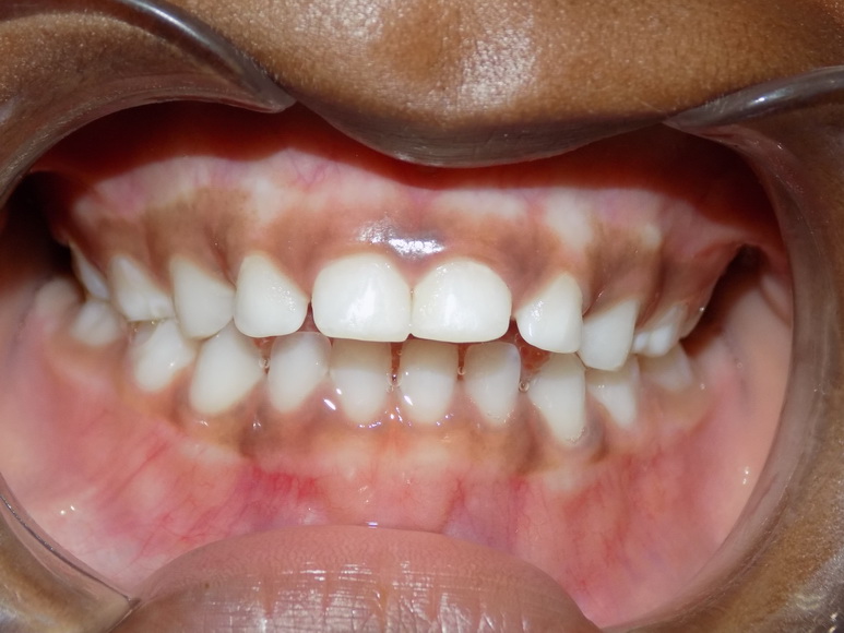 Maxillofacial Surgery Dental Korle Bu Teaching Hospital